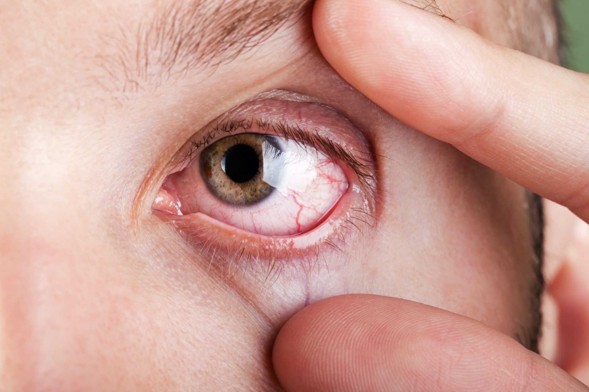 Homeopatia para alergia de pele: alergia nos olhos