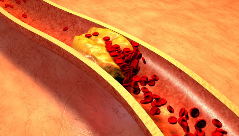 Colesterol alto pode matar Saiba como prevenir, os sintomas, como tratar e conheça opções de dieta